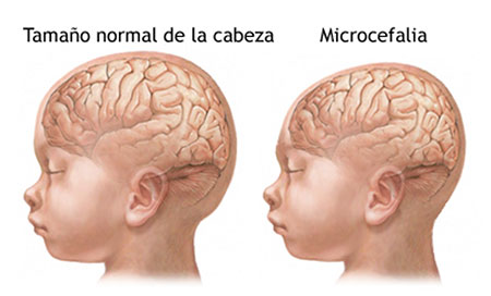 El primer caso de microcefalia en España  a causa del Zika
